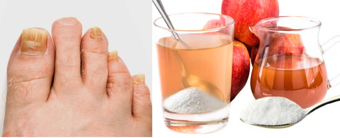 El hongo de las uñas en los pies ayrekomend